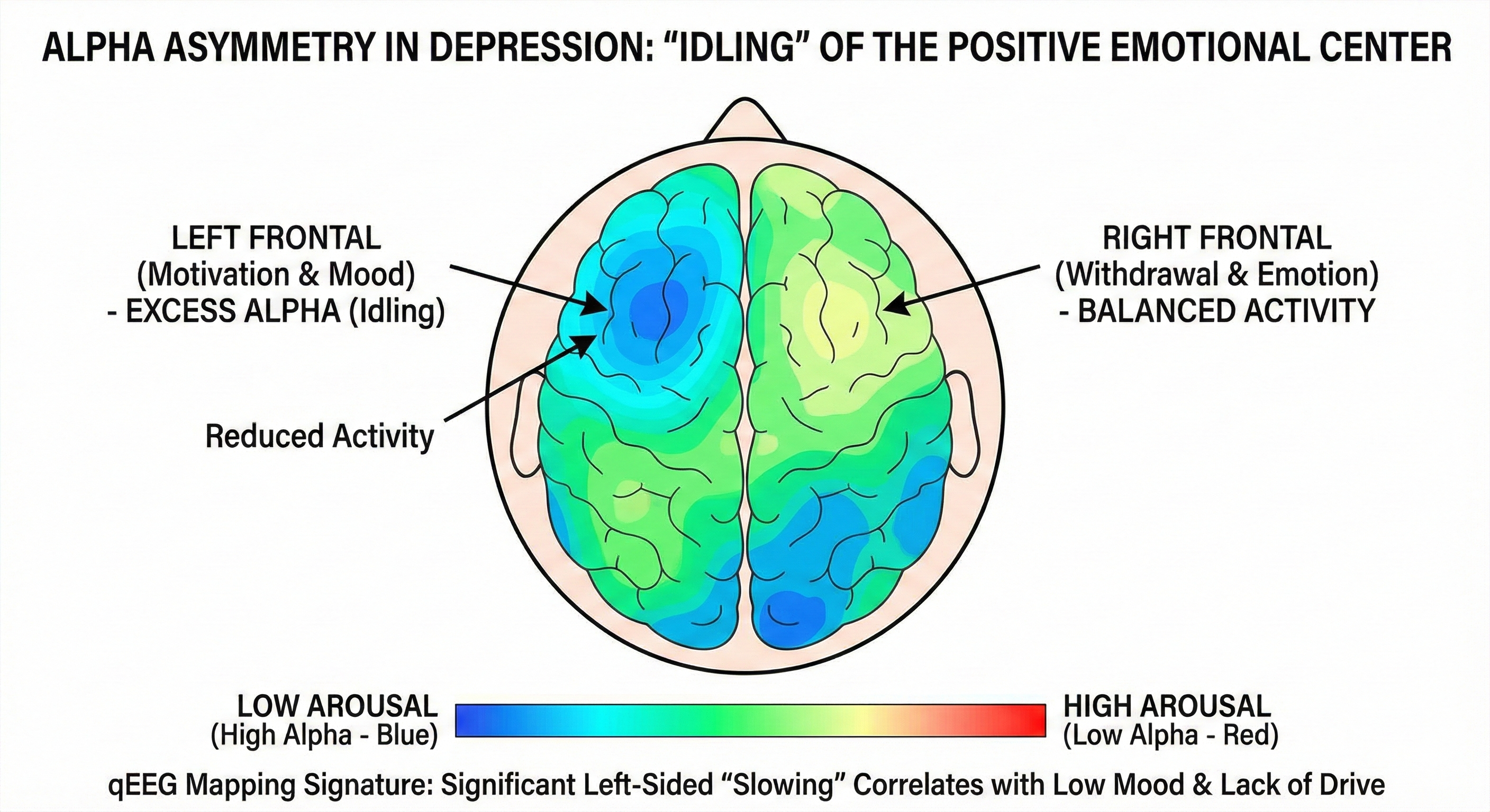 Alpha Asymmetry Brain Map for Depression
