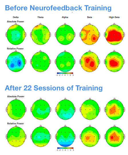 QEEG Brain Map comparison showing dysregulated activity versus healthy database